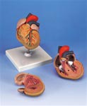 Classic Heart with Left Ventricular Hypertrophy (LVH), 2 part anatomical model